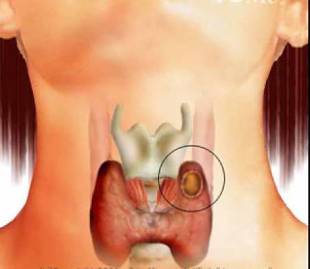Кистите на щитовидната жлеза не са опасни