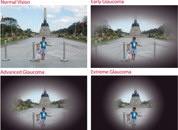 В Пловдив ще преглеждат безплатно за глаукома