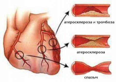 Микроваскуларна болест