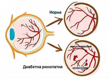 Диабетна ретинопатия