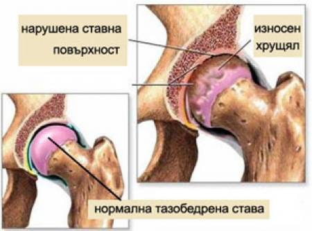 Спасението се казва „изкуствени стави“