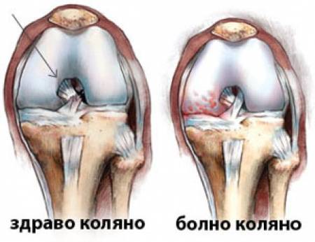 Лечение при вода в коляното