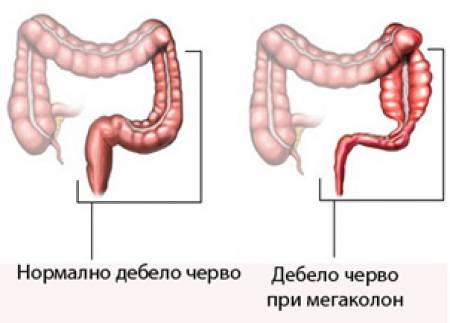 Мегаколонът - вродено състояние с опасни последици