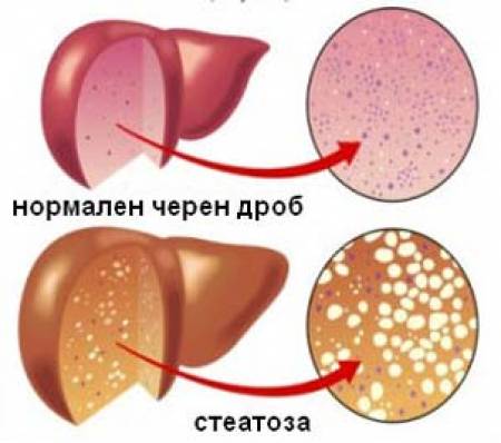 Коварната стеатоза