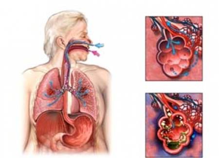 Пневмонията засяга белия дроб, но удря в сърцето