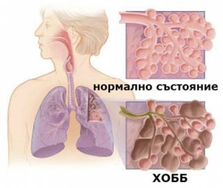 Започват да се обострят хроничните белодробни болести