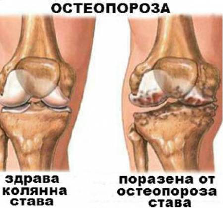 Лечение на остеоартрозата с лазер
