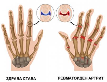 Артритът: митове и истини