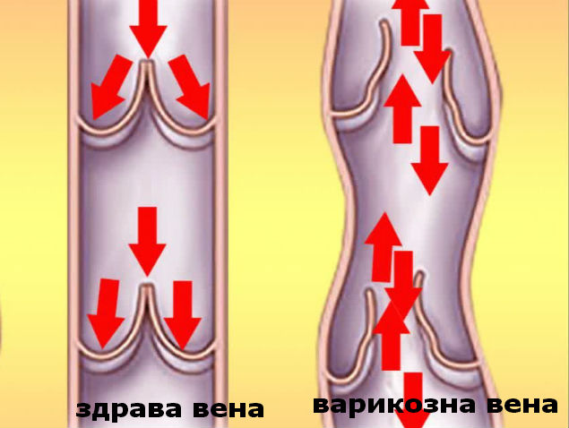 В Бургас ще преглеждат безплатно за разширени вени