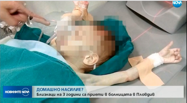 Близначета на 3 годинки са в болница, има съмнение, че са малтретирани от майката